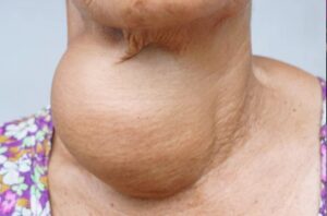 actual pic of goiter