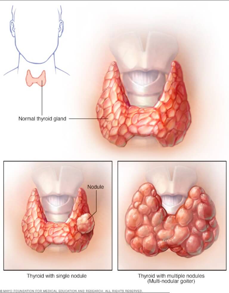 Структурные изменения щитовидной. Тиреоидит Хашимото зоб. Щитовидная железа симптомы щитовидной железы. В1 щитовидной железы т4n0m0.
